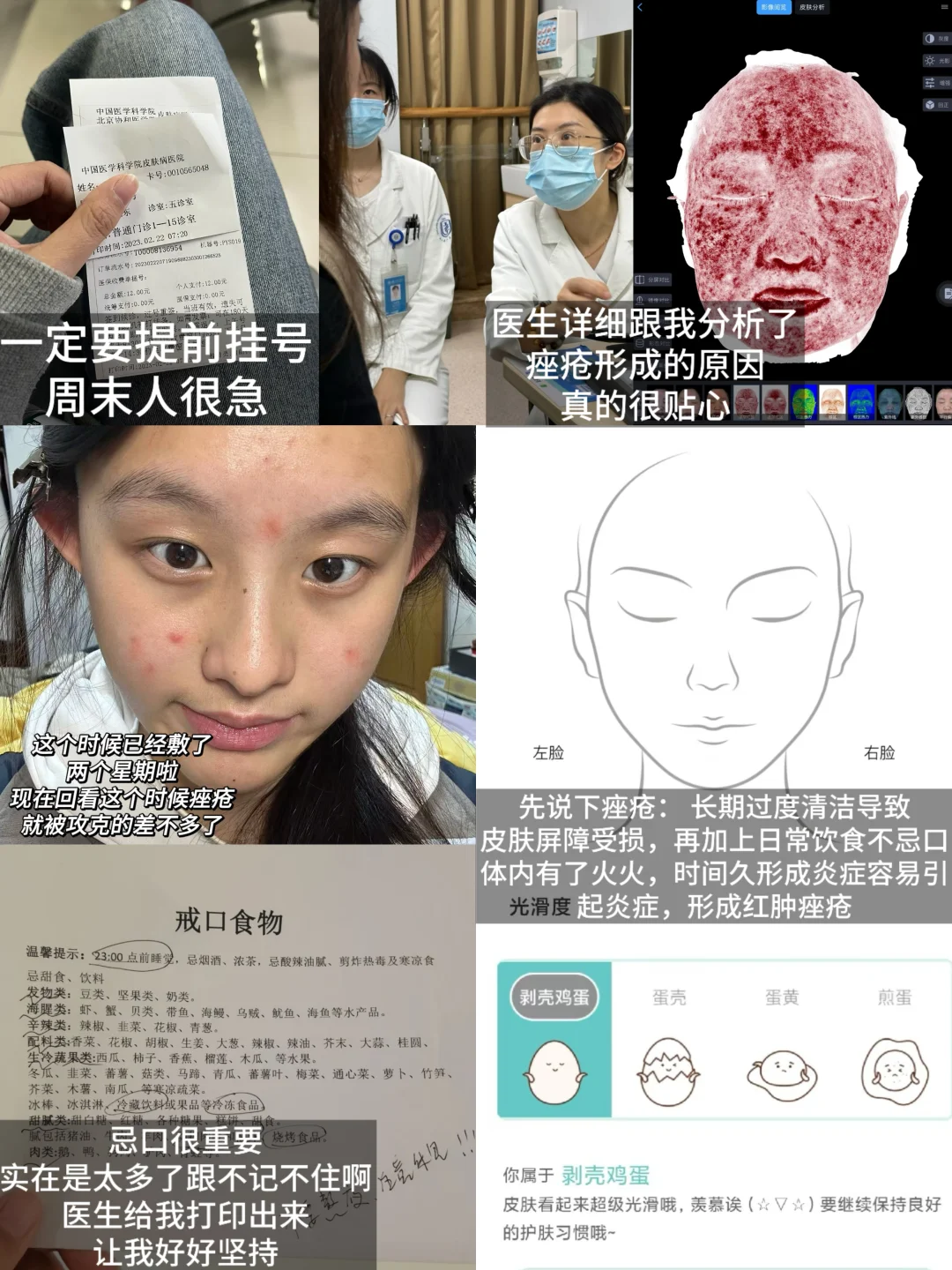 18岁青春女大，一月痤疮上岸，我做对了什么