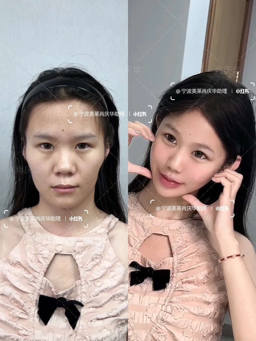 婆婆说颧骨高克夫???