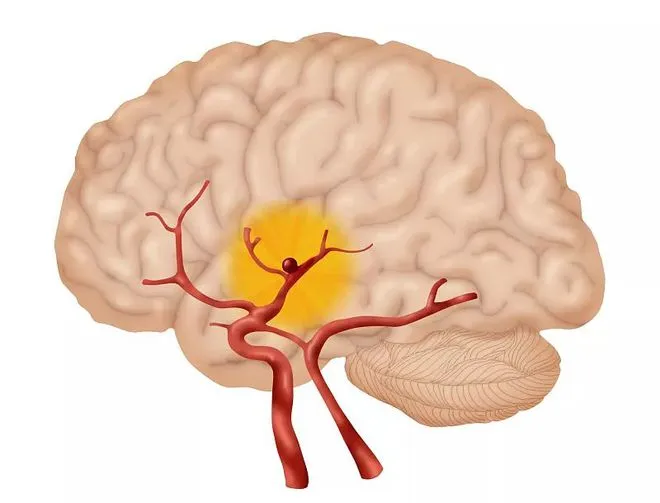 颅内“炸弹”，脑动脉瘤（不可作为医嘱哦）
