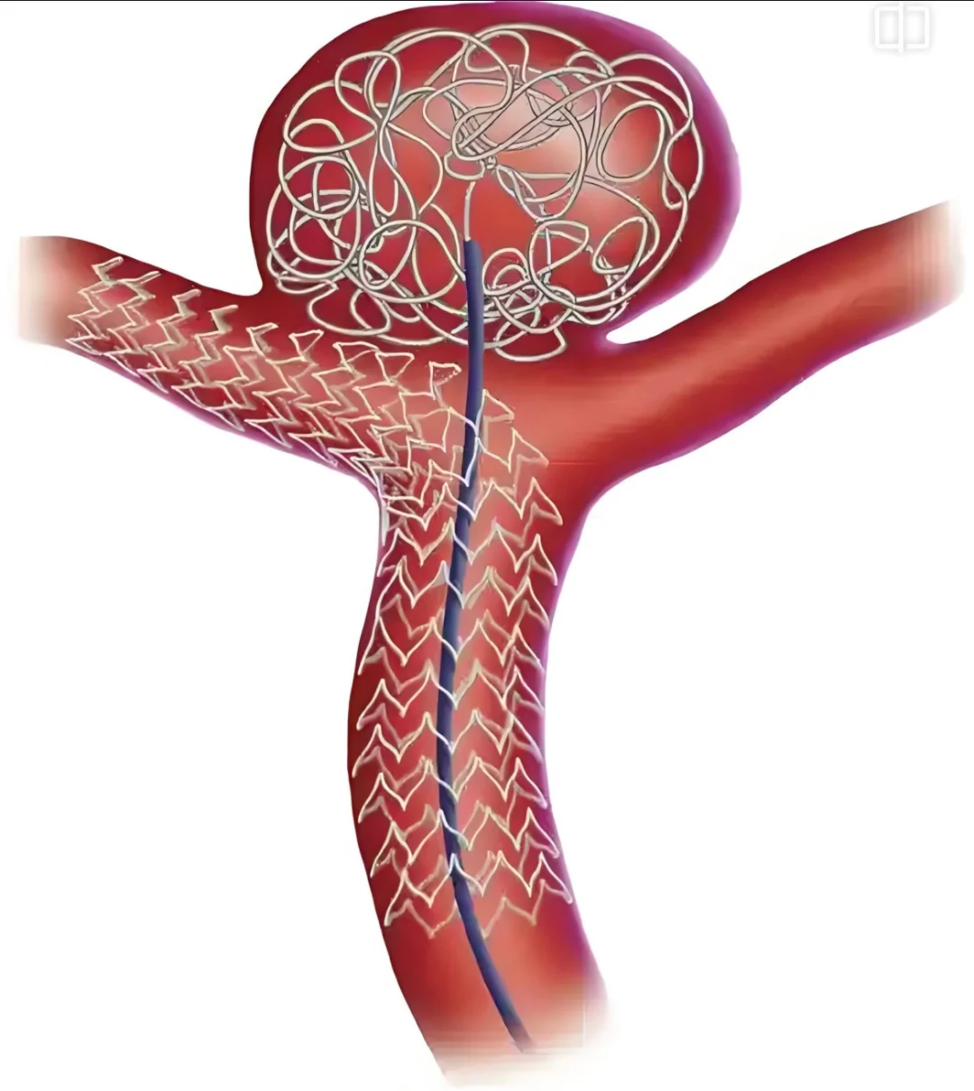 颅内“炸弹”，脑动脉瘤（不可作为医嘱哦）