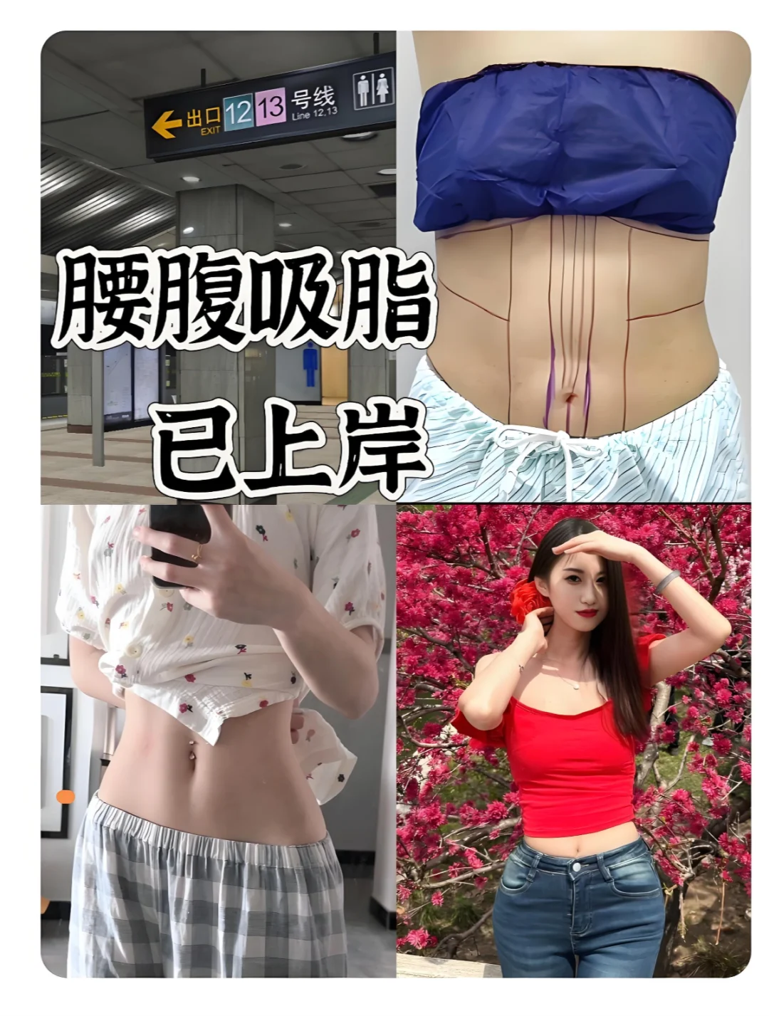 新年变美三件套，第一件:腰腹吸脂!!!