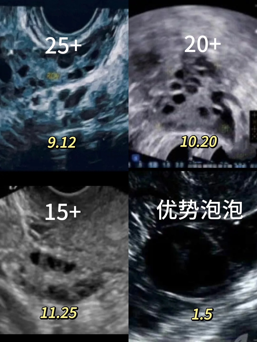 第一次感受到了揉腹对多囊的V 力！