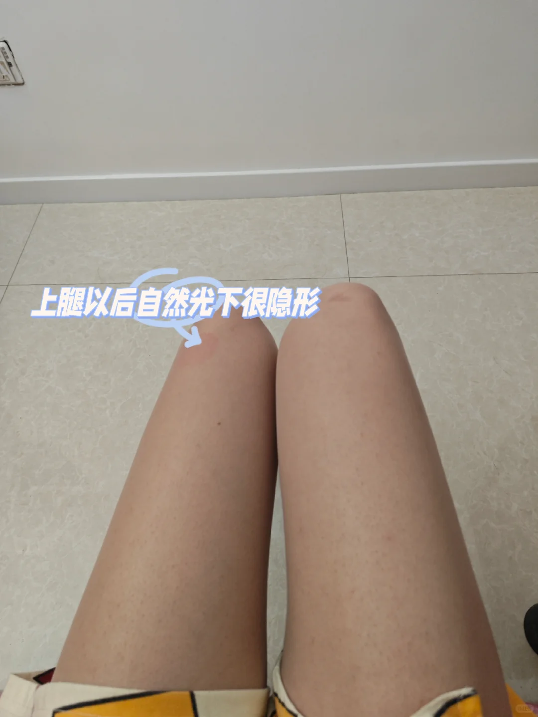 科胡特：NPD痴迷丝袜源于心理创伤