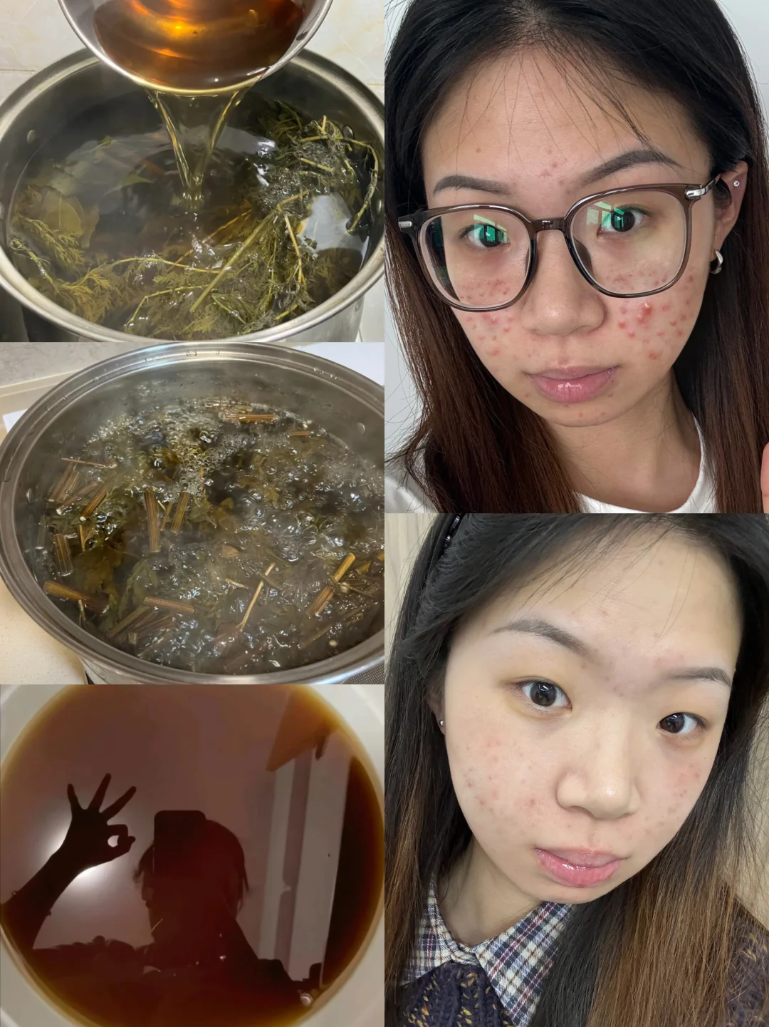 重度痘印女大用艾草湿敷打卡一个月！