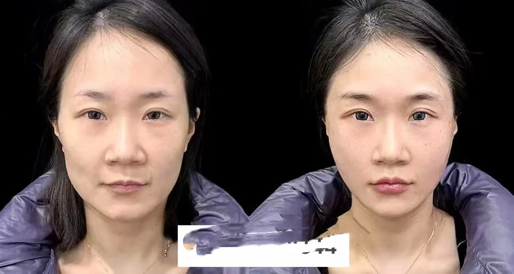 好看的脸要皮肉贴合 深层有支撑 浅层有收紧