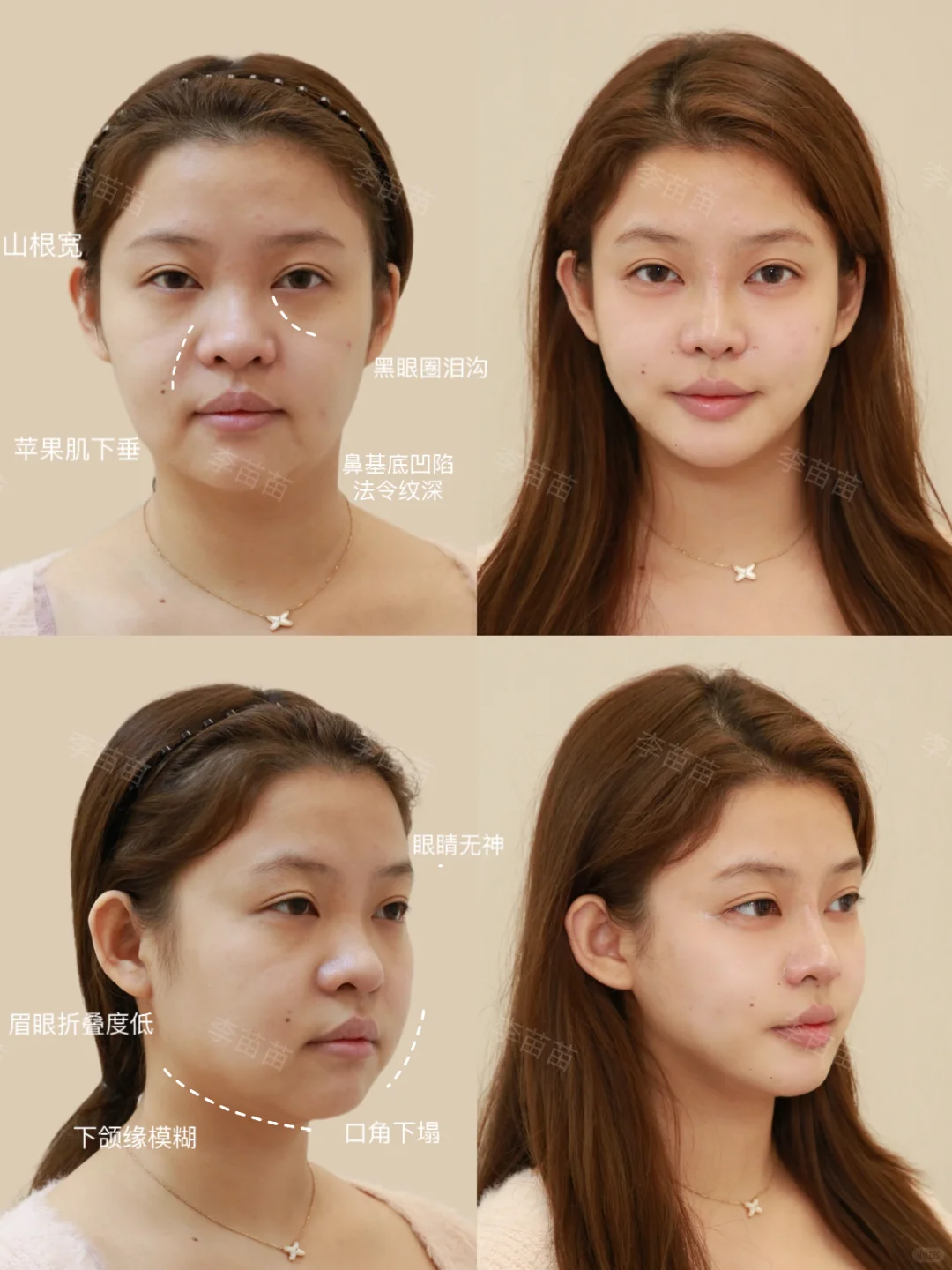 疲态肉肉脸微调～韩女就这么水灵灵出来了