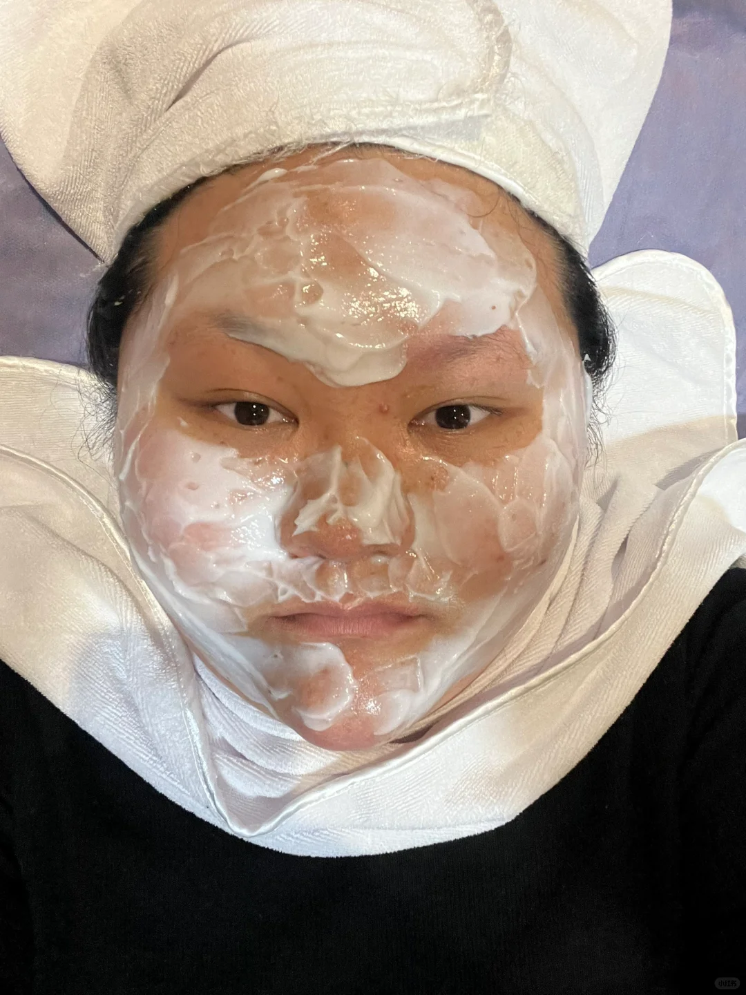 25岁 第一次做医美项目