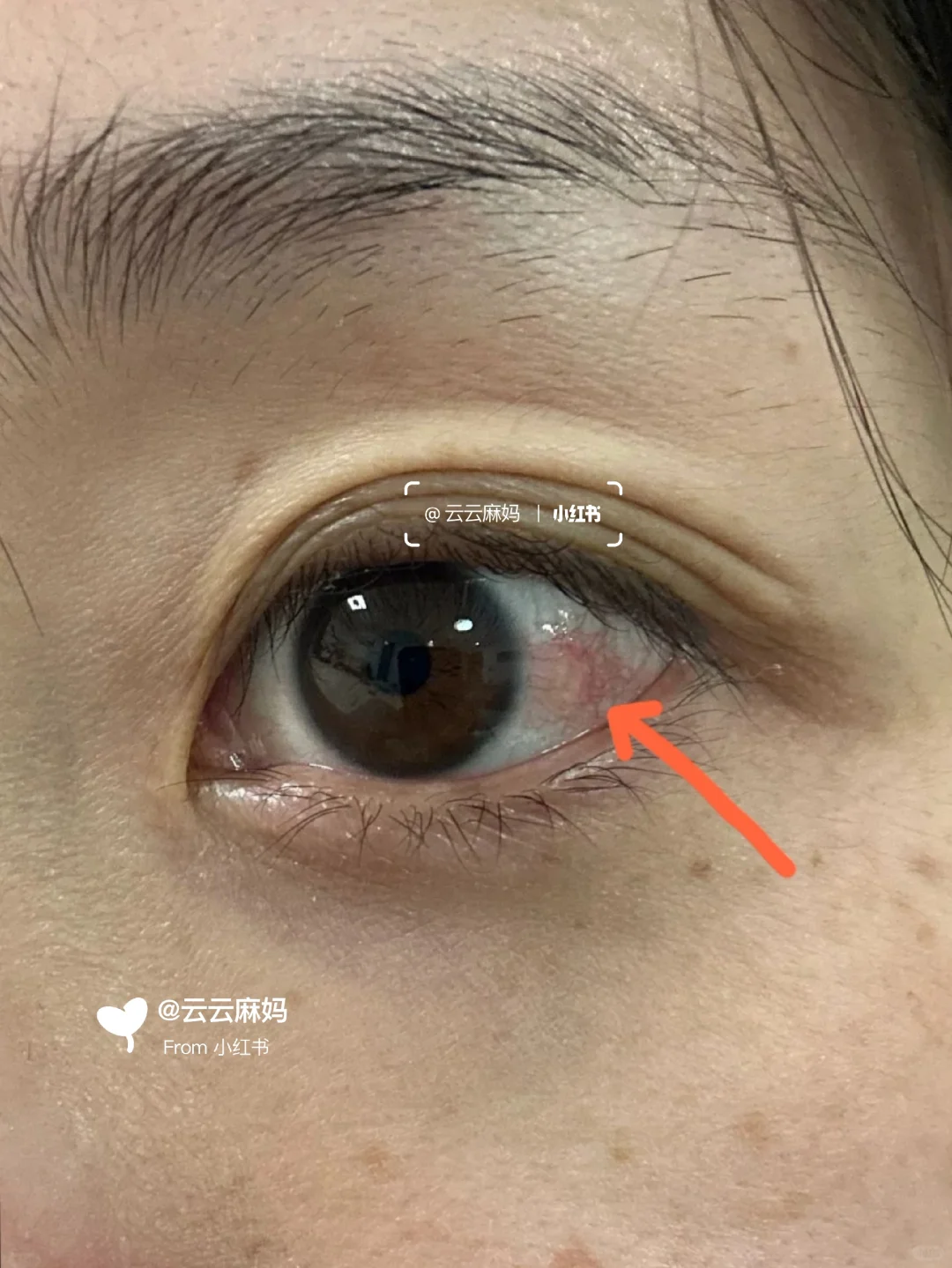 干眼症，已正常！