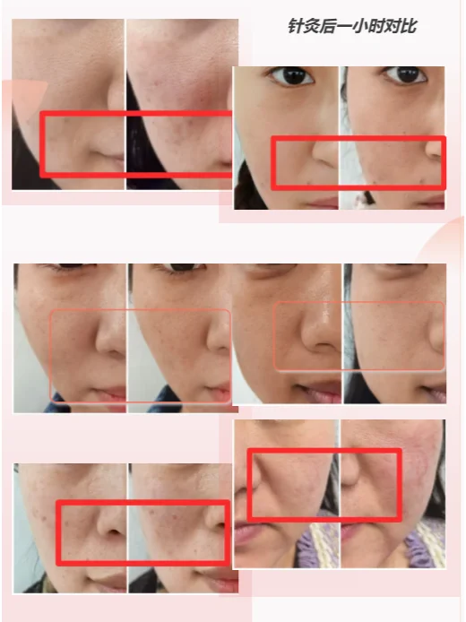 面部针灸：不注射、不动刀的自然年轻术