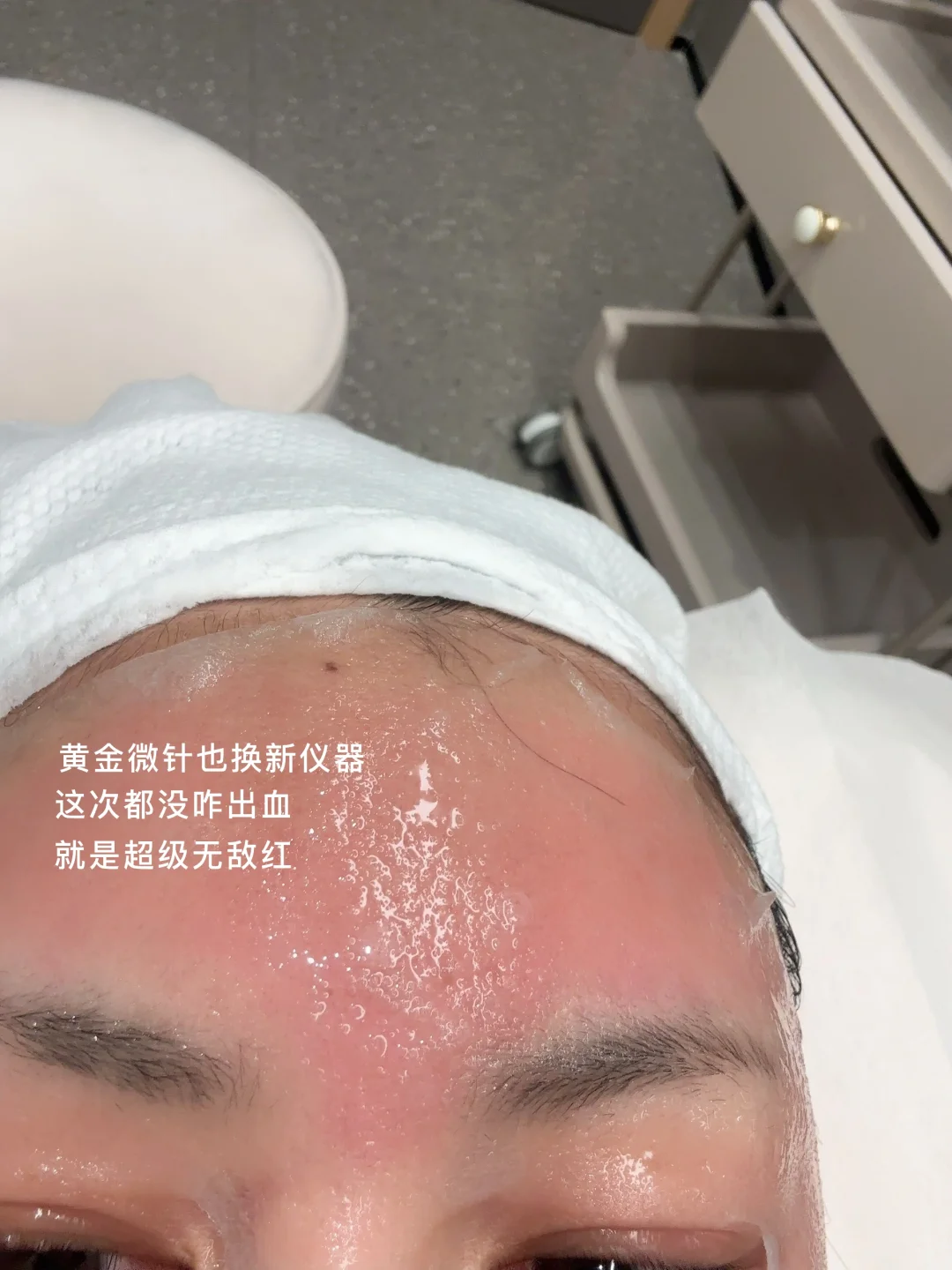plog日常|打工人周末逆袭变美🥰黄金微针