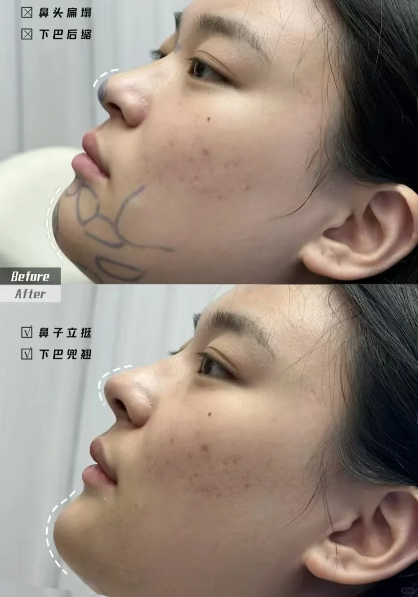 面部轻盈感塑造