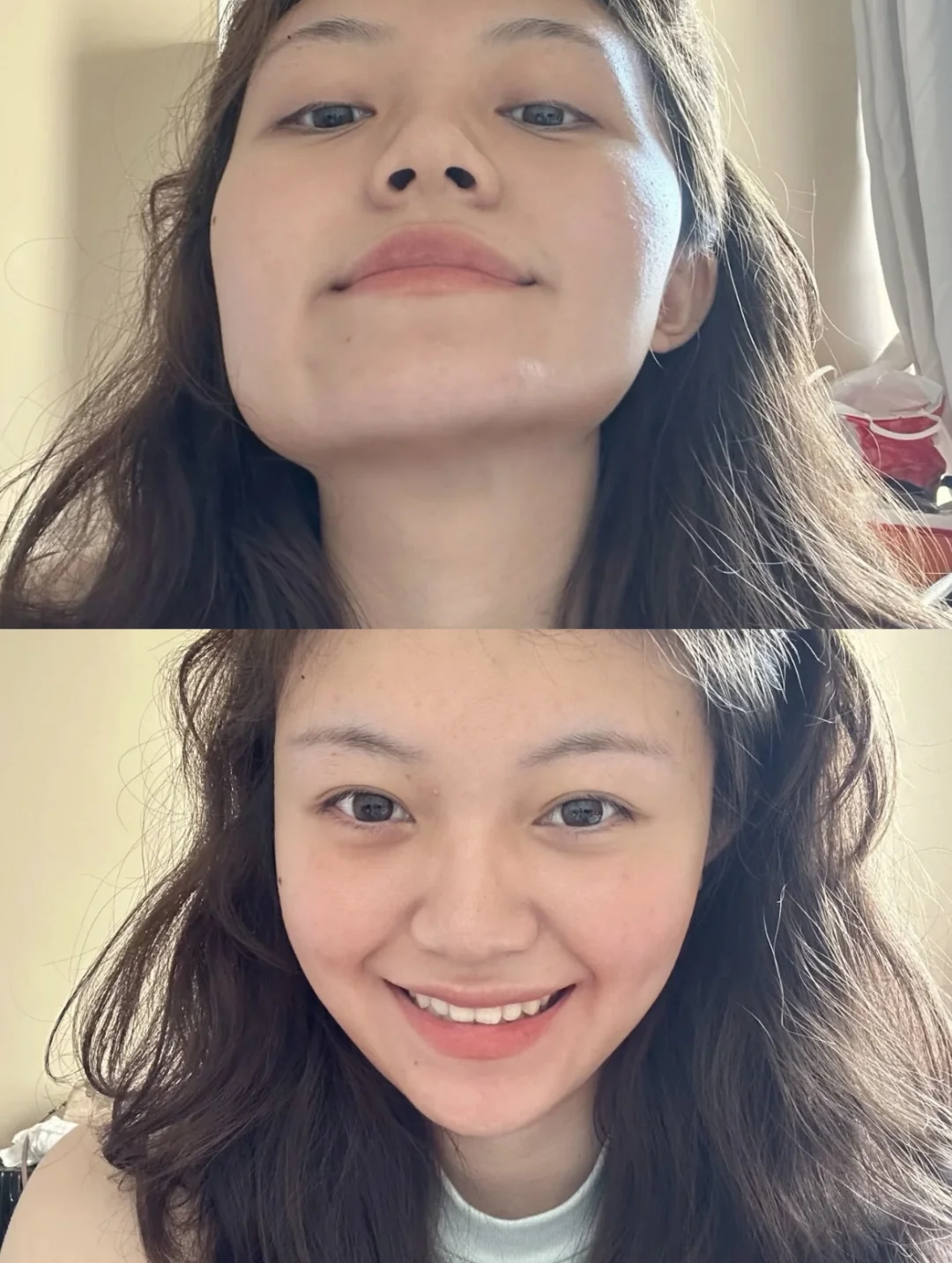 深圳颞下颌关节紊乱针了6次，美我一大跳！