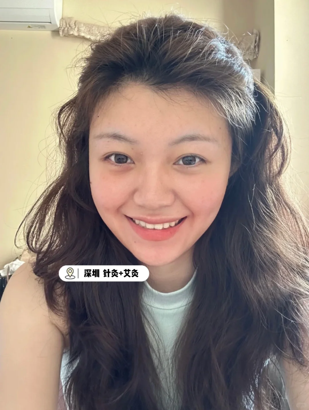深圳颞下颌关节紊乱针了6次，美我一大跳！