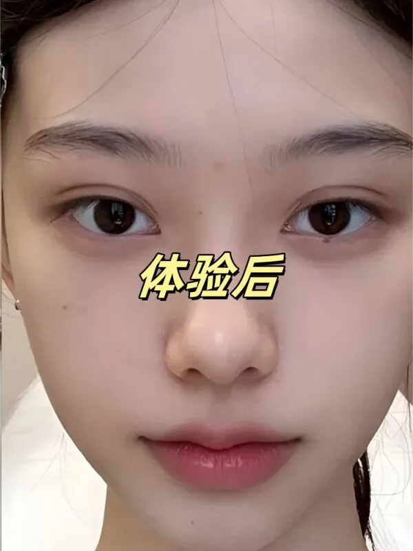 玻尿酸全脸填充后…我直接换头了？！