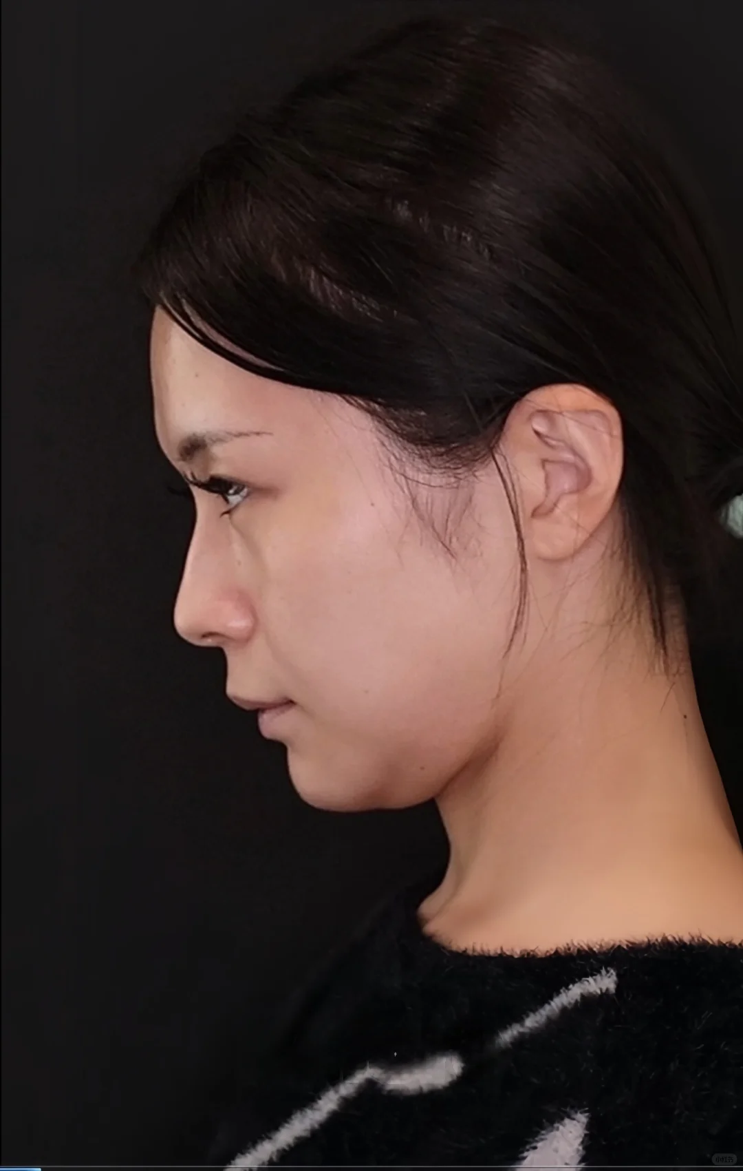 女大学生下巴变美小秘密