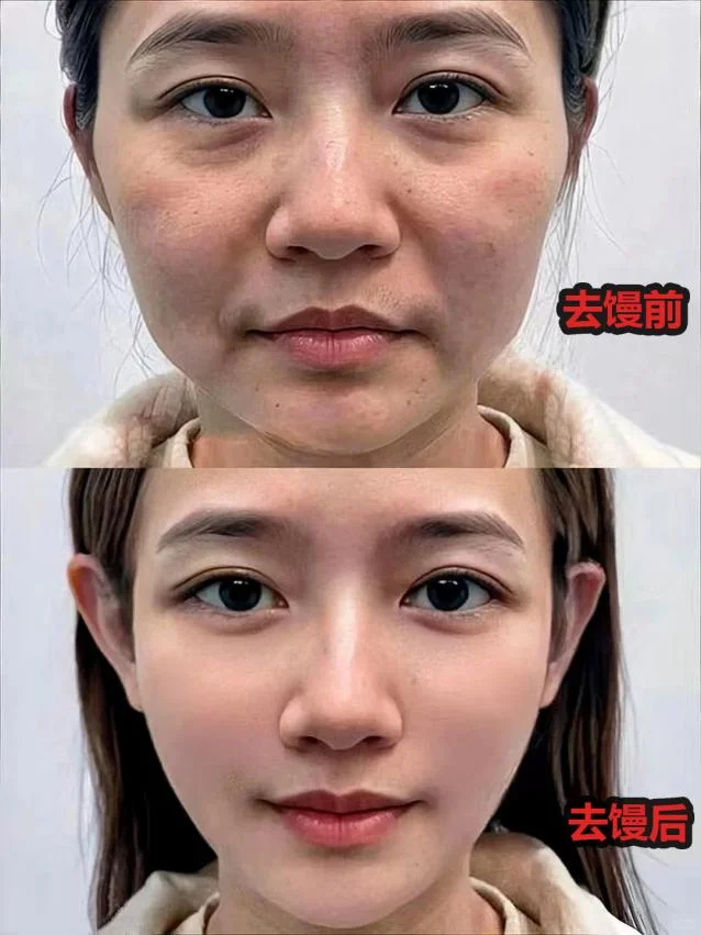 馒化修复成功|轻松蜕变