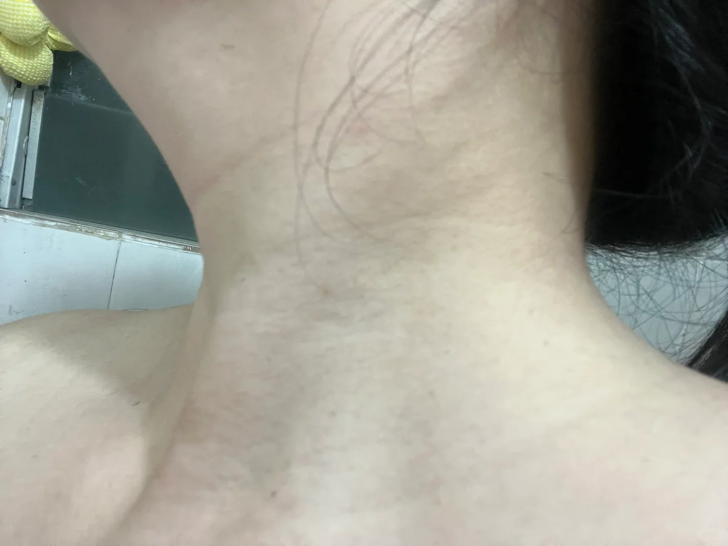 我这是胰岛素抵抗吗 好怕