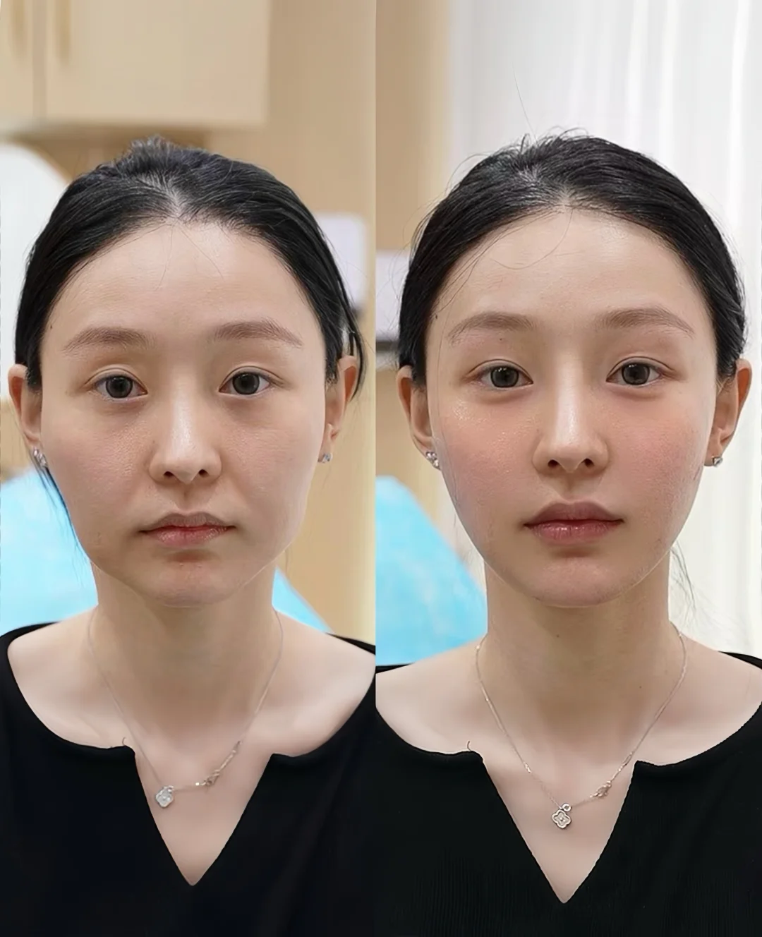 轮廓调整 变美