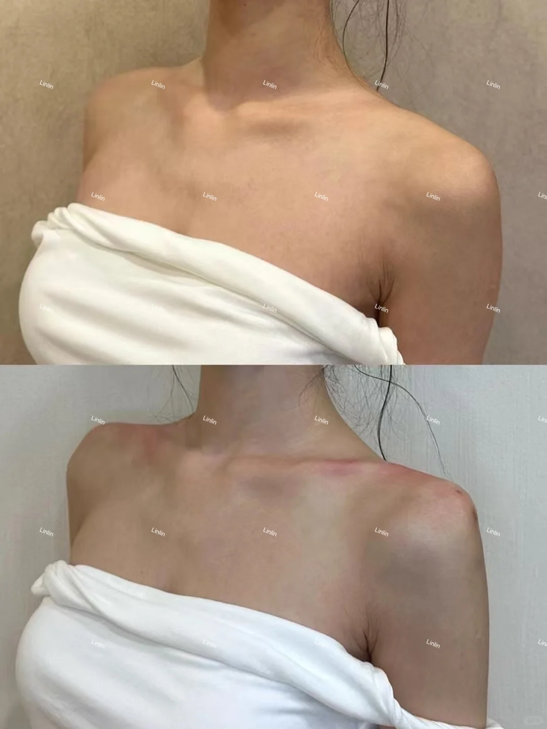 直角肩 锁骨线