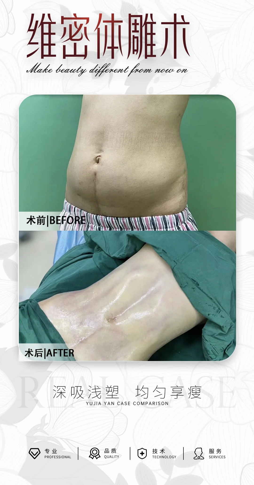 腰腹环吸 +维密体雕术