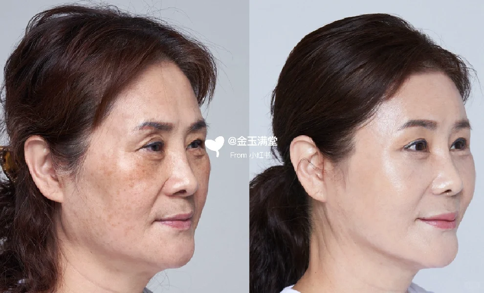 谁懂啊，do脸之后面部直接减龄10岁～