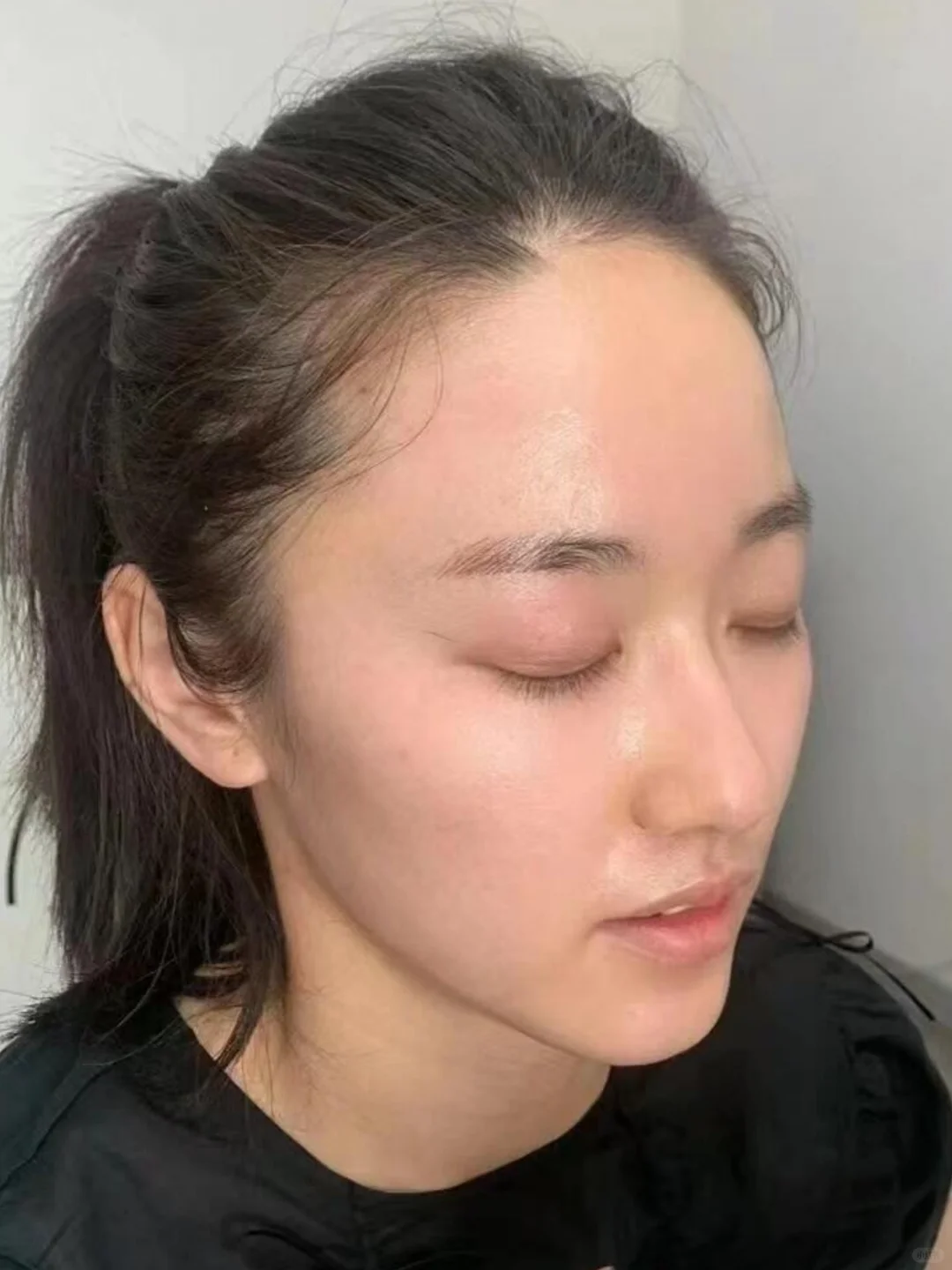 记录黄褐斑三个月的变化还不错吧？