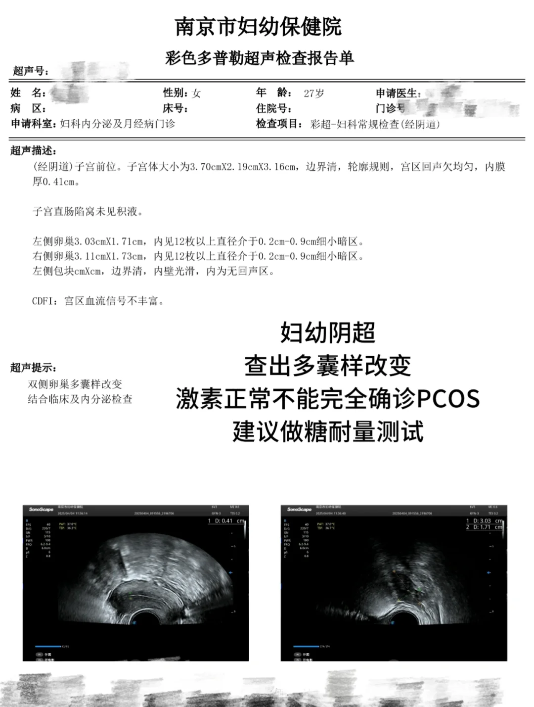多囊→胰岛素抵抗 | 我的确诊经历分享