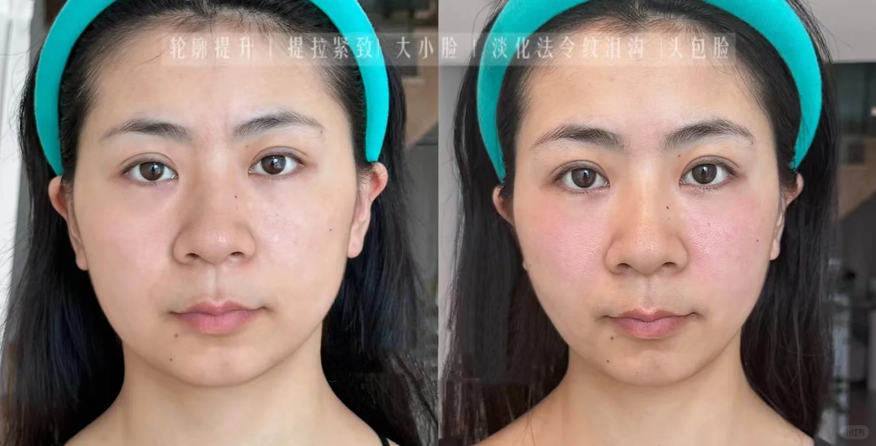 小颜整骨的高级美
