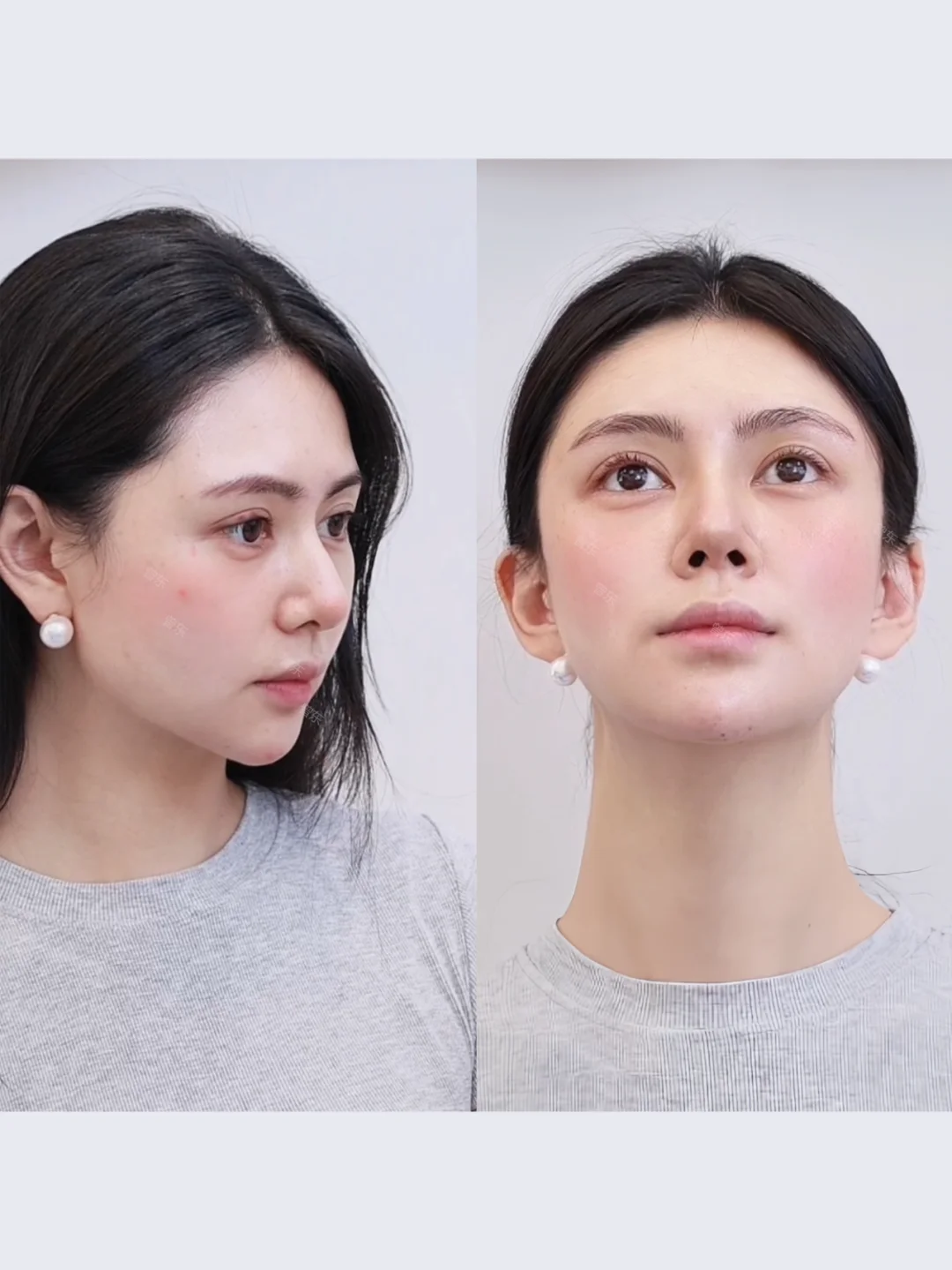 面部提升 | 方圆脸Do完脸后