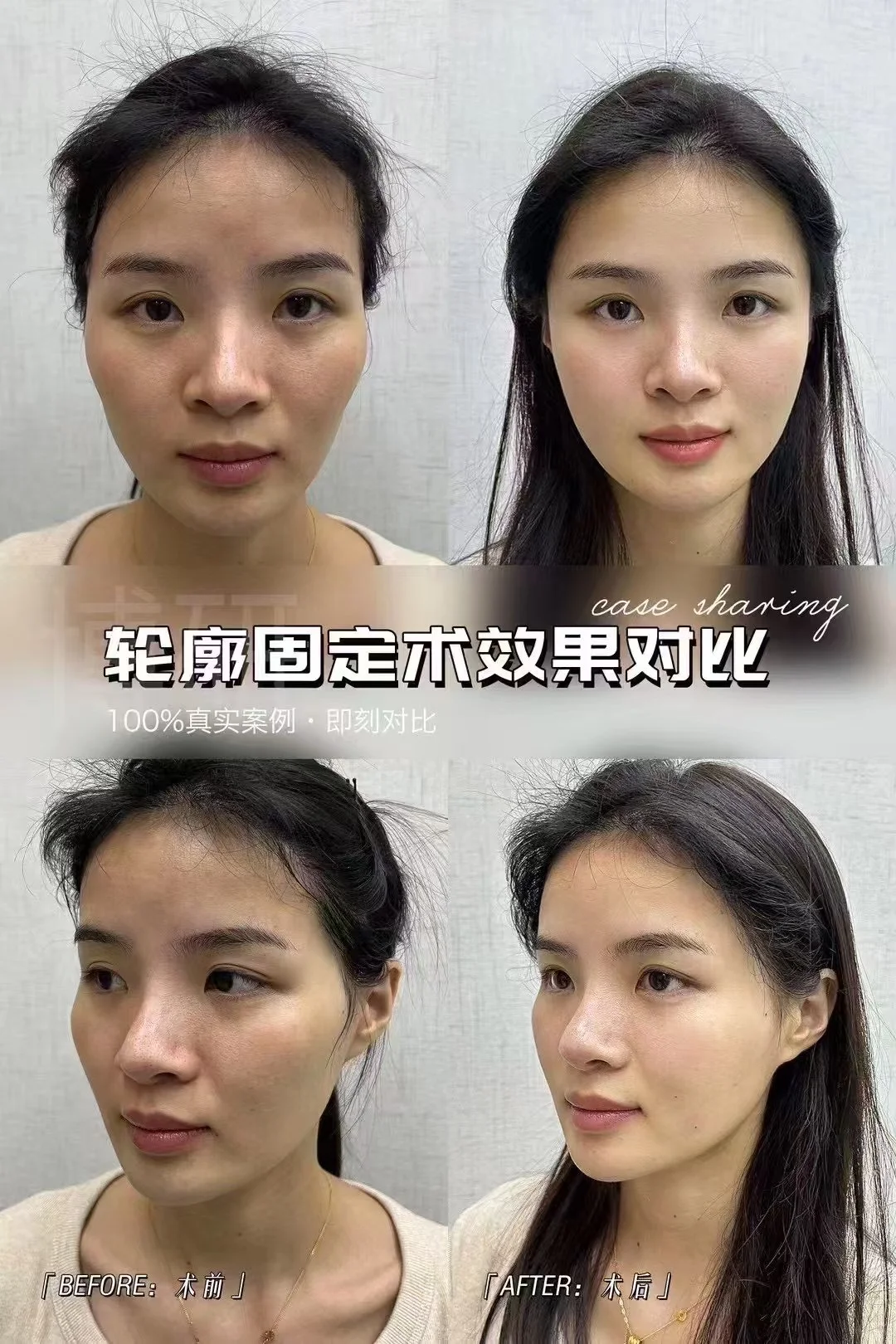 轮廓固定改善轮廓