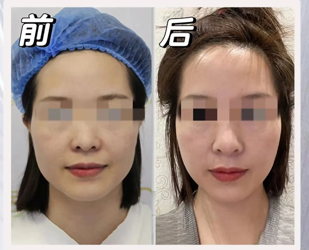 面部提升管理