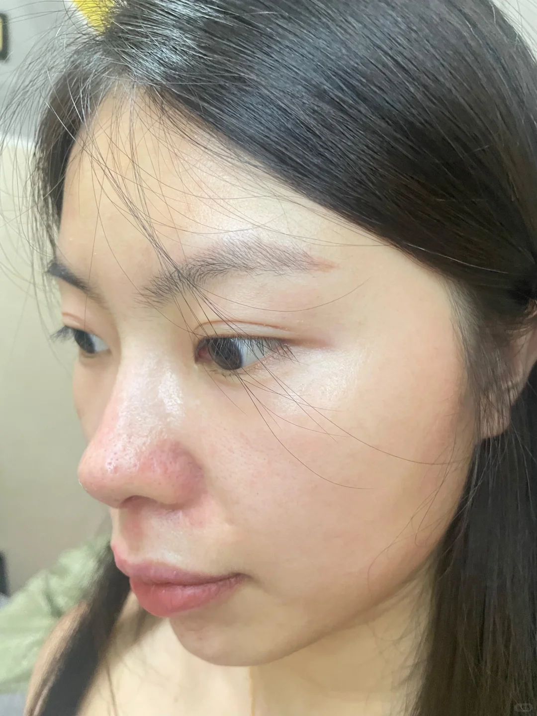 淡斑记录的第三个月，没有了