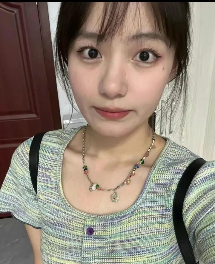 美女脸上白癜风几个月。干干净净。