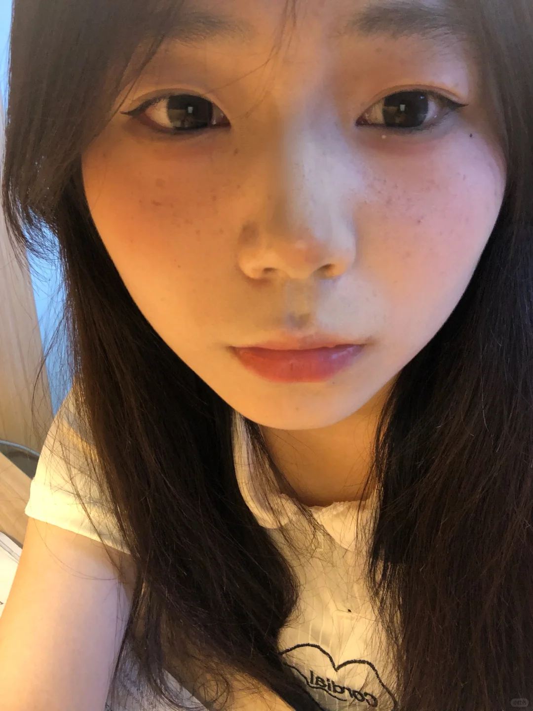 雀斑