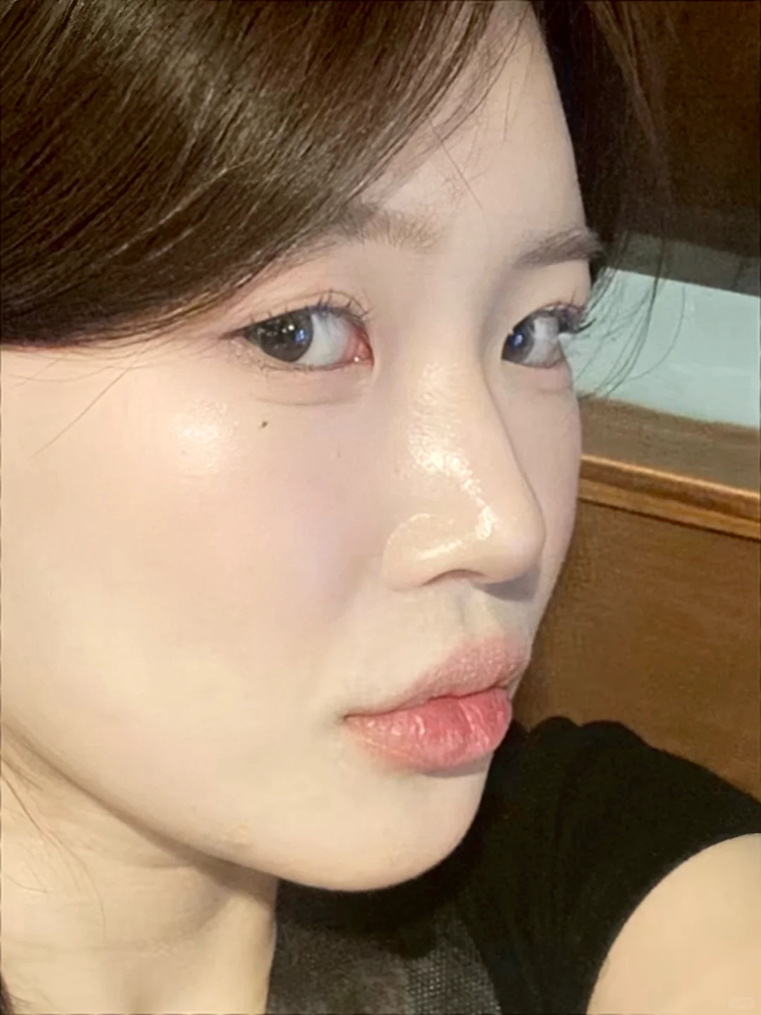 28岁鼻子旁边的凹陷怎么救？！