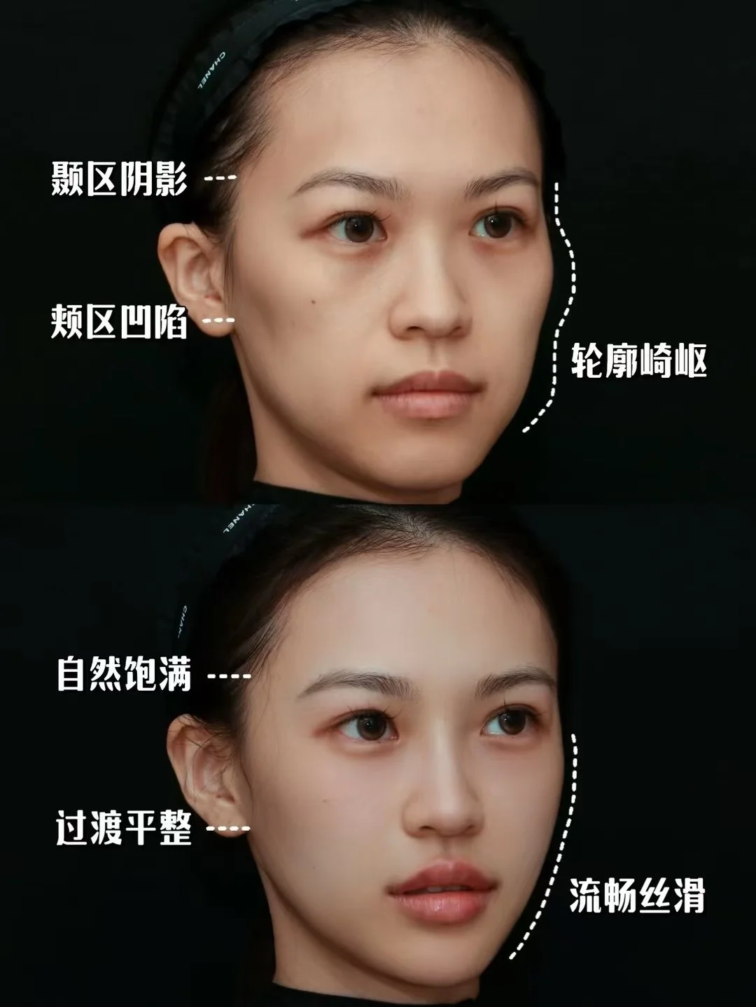 原相机轮廓微整案例～