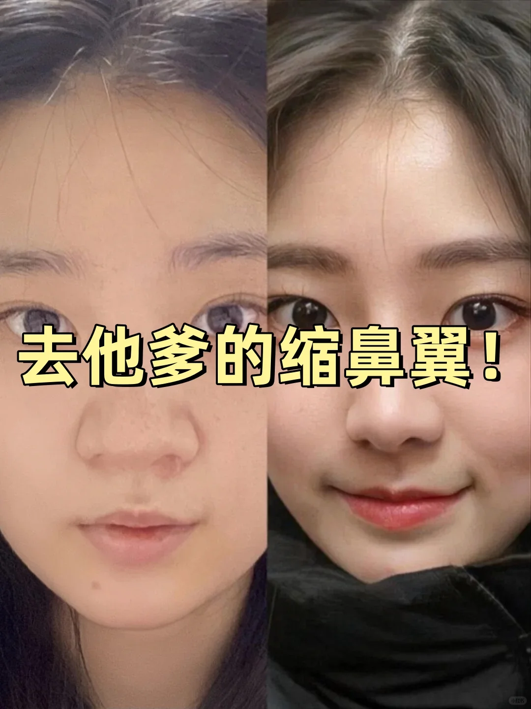 离职后才敢说的缩鼻翼內幕…