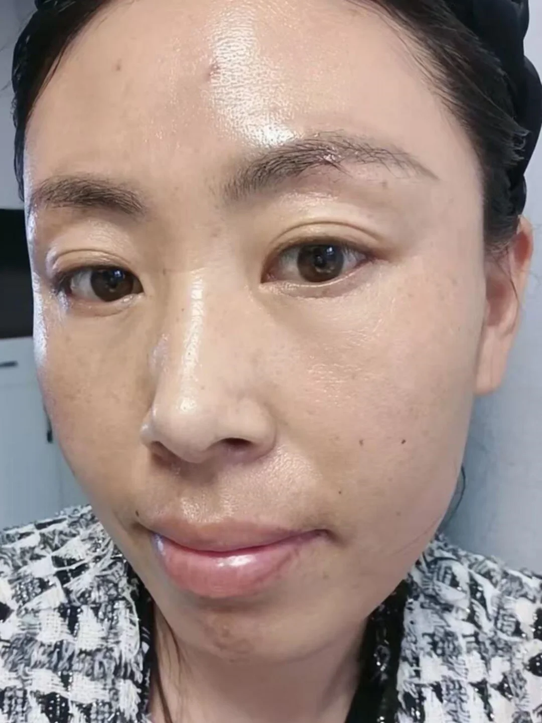 记录淡化黄褐斑的四个月，已经看不出来了