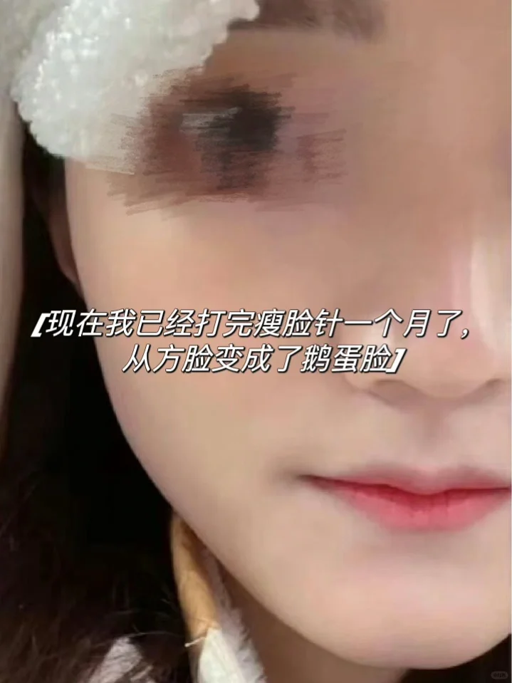 脸大脸宽下颌方，这些姐妹也能打瘦脸针吗❓