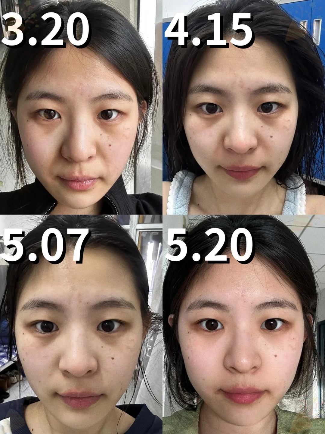 00后射手女坚持淡化法令纹的2个月