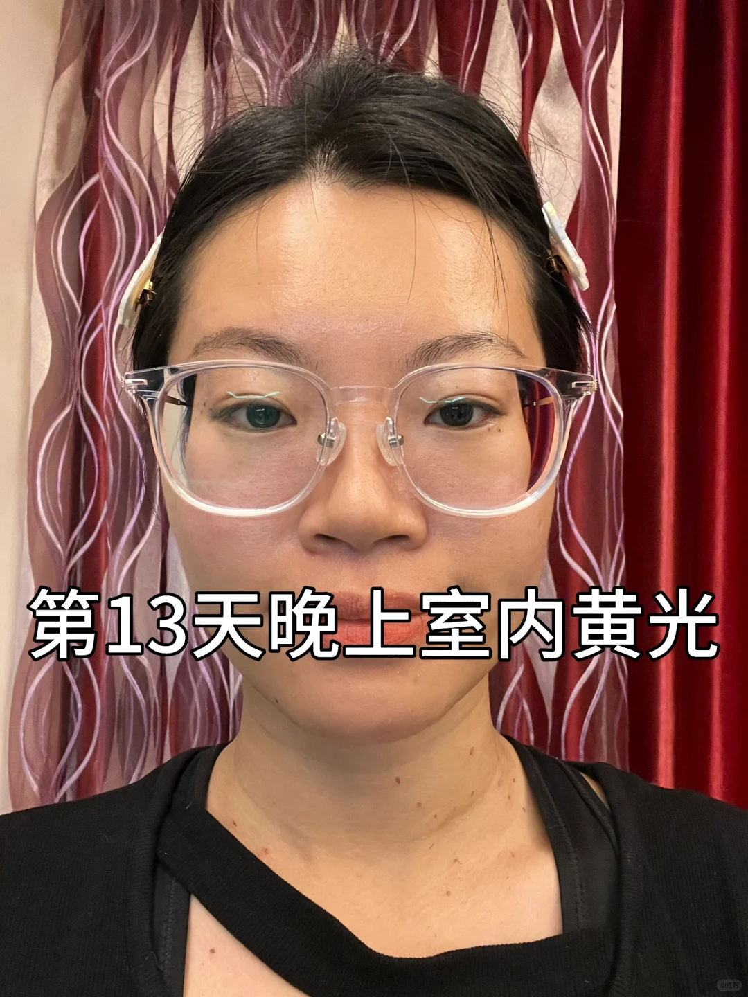 光子嫩肤 前后对比图 素颜 医美对比