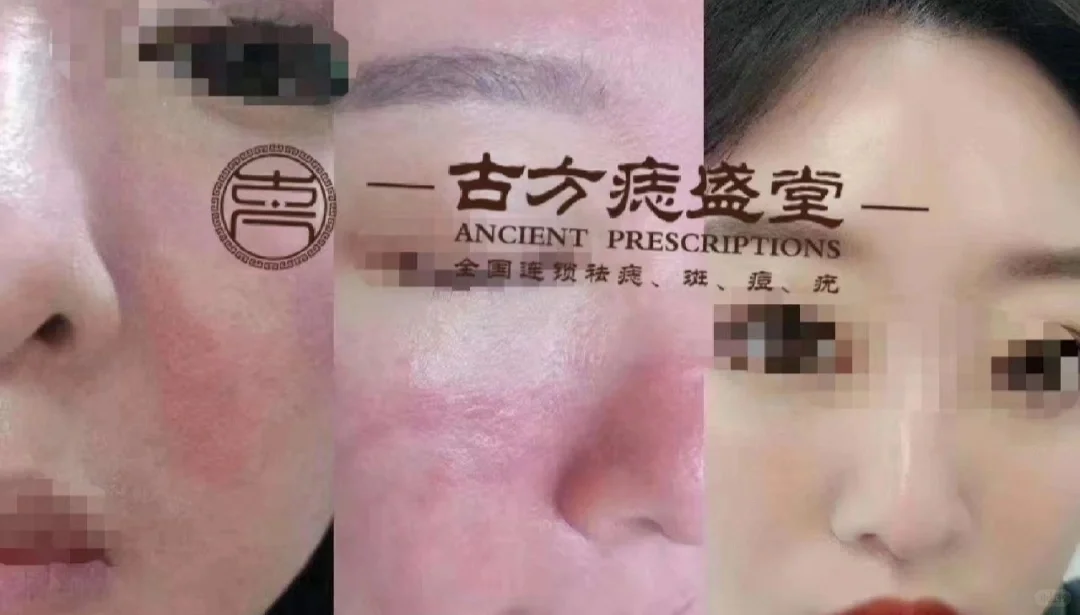 激素脸