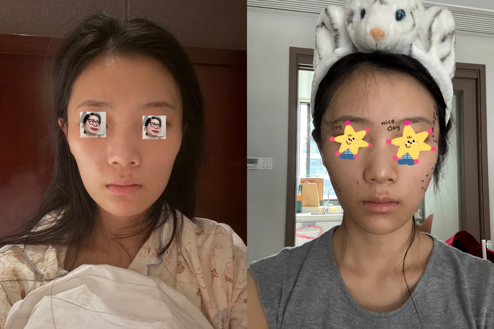 补凹陷第九天，好后悔没有早点填啊