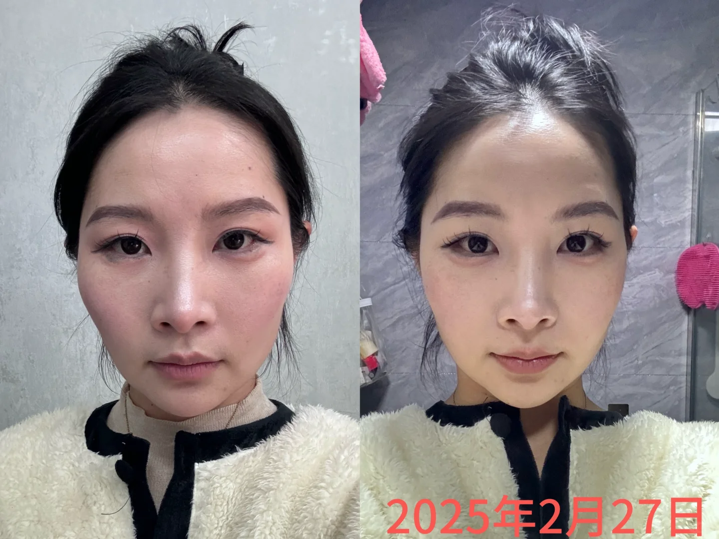 30多年的高颧骨竟然用5天就消了！！！