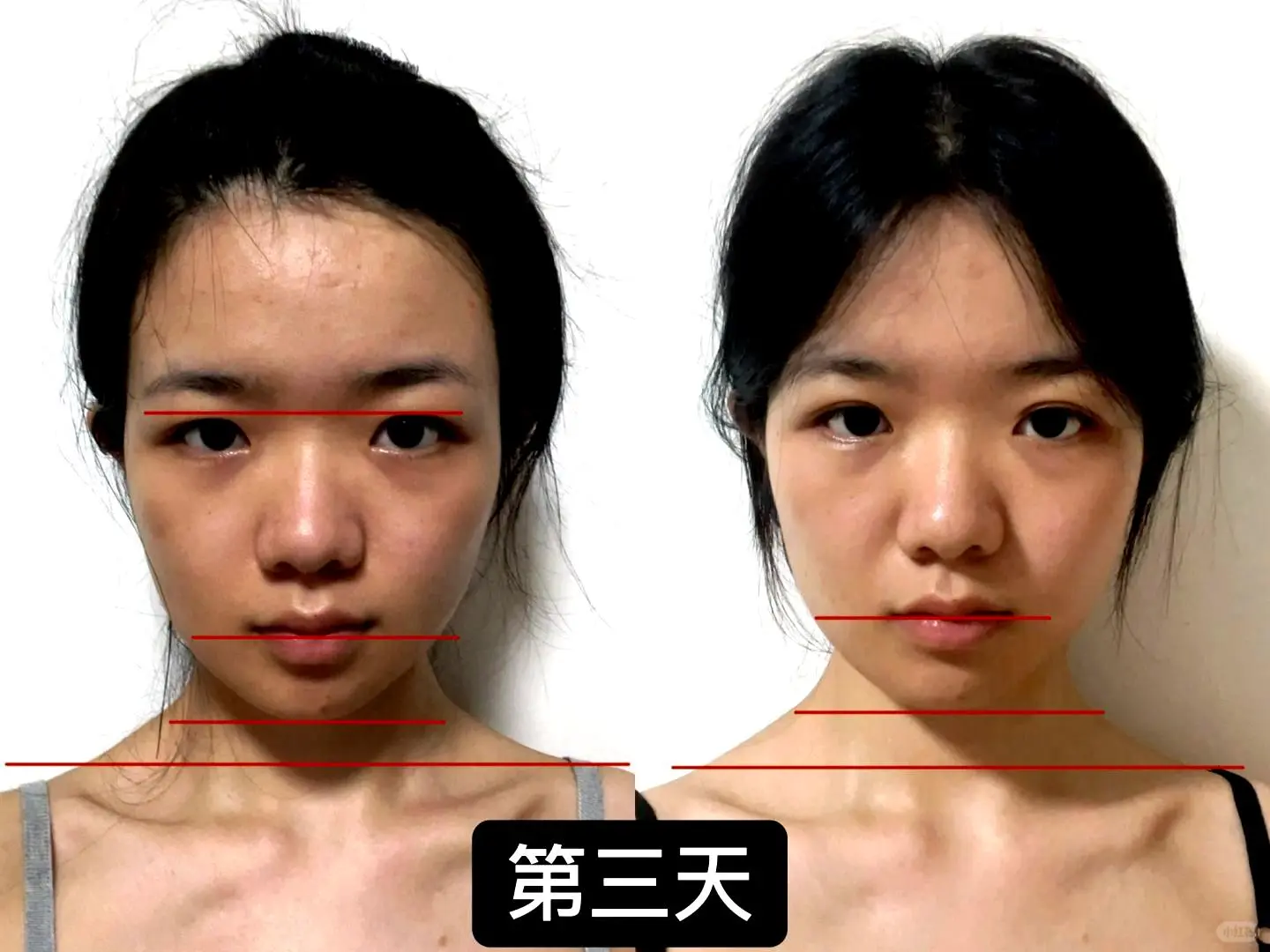 纠正歪脸第三天，美丽蜕变进行时！