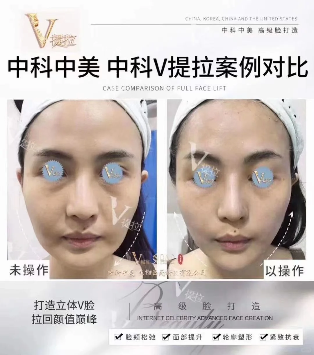 中科v提拉对比图