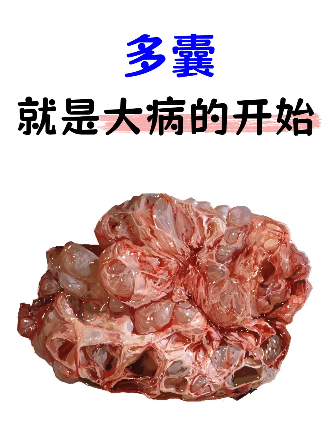 我用过最顶级的药方——多囊