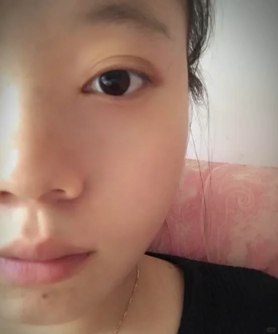 终于把脸上的胎记搞定了