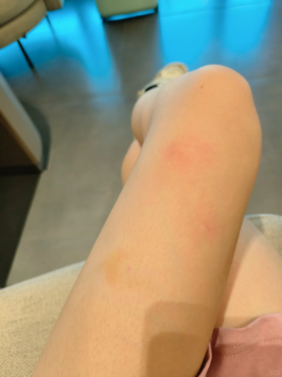 被蚊子咬成这样，这腿还有救吗?