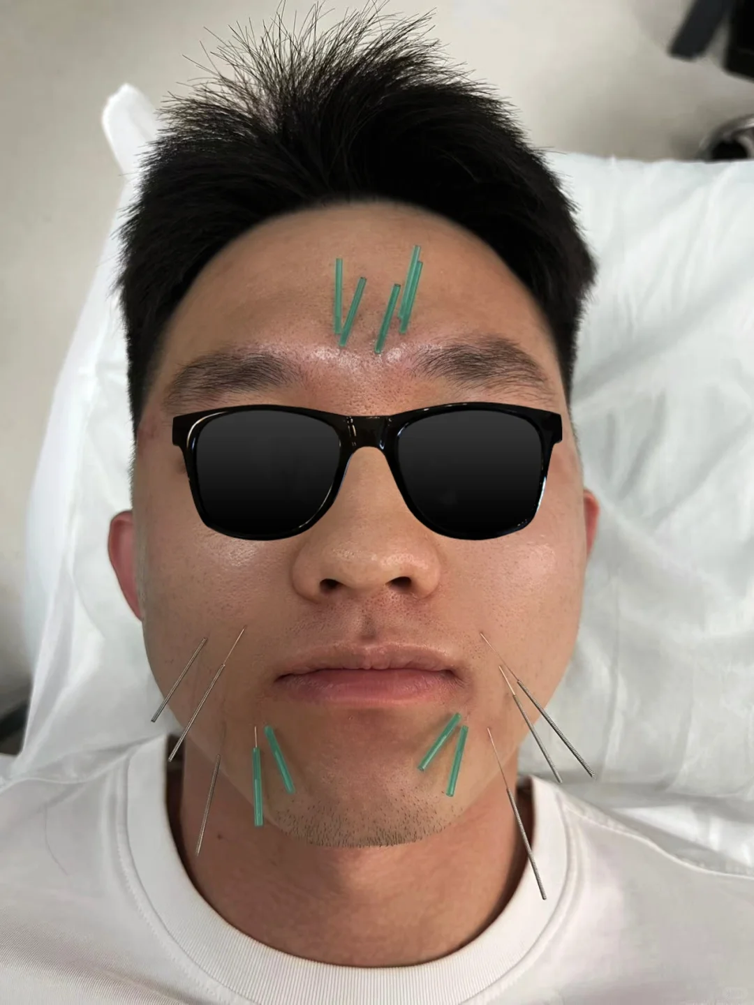 服！两次中医针灸美容，皮肤白到新高度